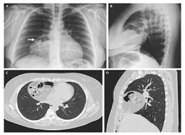 <p><strong>Ultrasonografi (US)</strong></p>

<p>